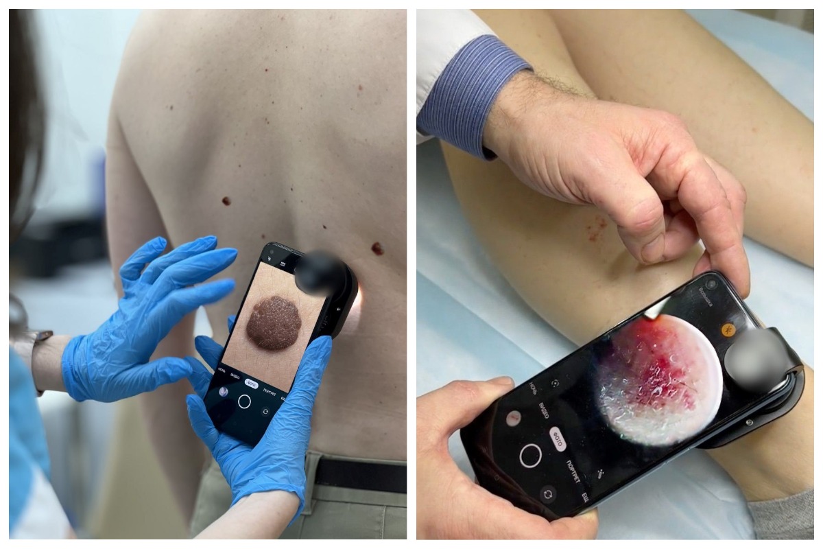 Дерматоскопия со скидкой в МЦ «Чистая кожа»: проверьте родинки вовремя